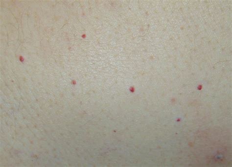 Red Spots Cherry Angioma With Images Skin Spots Cherry Angioma Dots