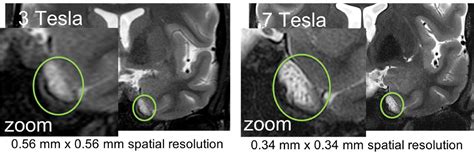 High Resolution Mri For Exposing Cancer Spread In The Brain National
