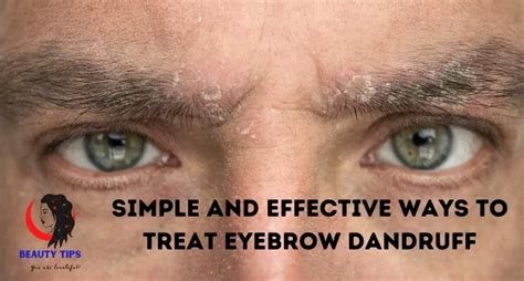 Eyebrow Dandruff Symptoms Causes Treatments And Prevention
