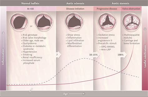 Aortic Valve Stenosis — From Patients At Risk To Severe Valve Obstruction Nejm