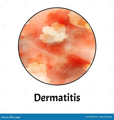 Skin Inflammation Dermatitis Skin Infographics Vector Illustration