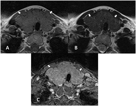 Frontiers Magnetic Resonance Imaging Features Of Normal Thyroid