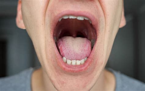Dilansir dari laman sciencealert, para studi terbaru ini menemukan lebih banyak contoh gejala yang berhubungan dengan kulit daripada banyak penelitian sebelumnya, jadi mungkin ada. Waspada Gelaja Baru COVID-19, Muncul Ruam Di Mulut Pasien ...
