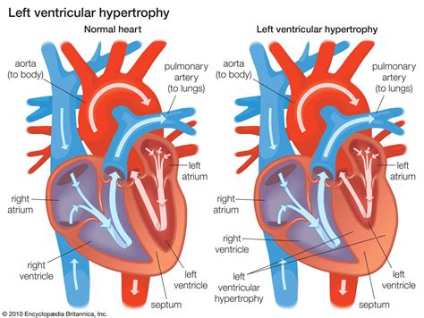 Cardiovascular Disease Ventricular Dysfunction In Heart Failure