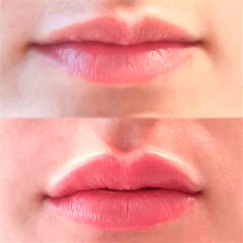 caso de éxito en un tratamiento de relleno de labios con ácido hialurónico clínica estética
