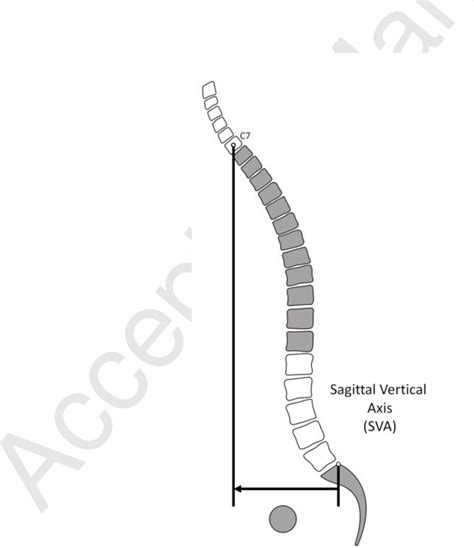 Sagittal Alignment Of The Spine What Do You Need To Know Semantic