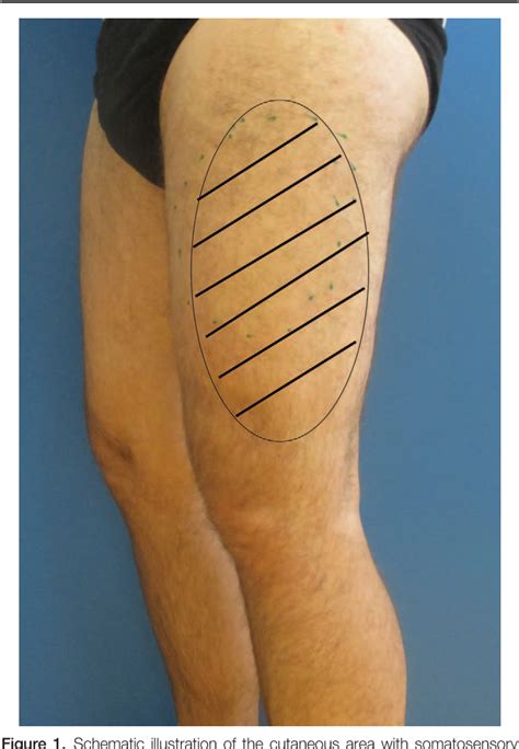 Surgical Decompression Of The Lateral Femoral Cutaneous Nerve Lfcn