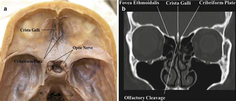 The Sinonasal Anatomy Endoscopic Lacrimal And Orbital Perspectives