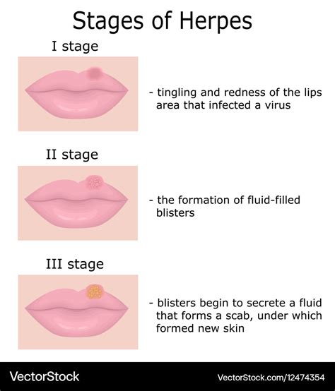 Stages Of Herpes Royalty Free Vector Image Vectorstock