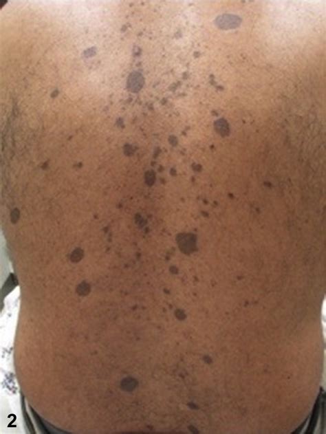 Progressive Hyperpigmented Rash In A Middle Aged Man Journal Of The