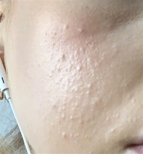 Thousands Of Bumps On My Face General Acne Discussion Acne Org Forum