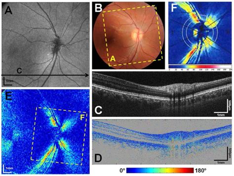 Wide Field Ps Oct Imaging Of The Human Retina A Fundus Projection