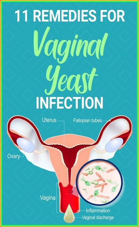 Everything You Should Know About Vaginal Yeast Infection Artofit