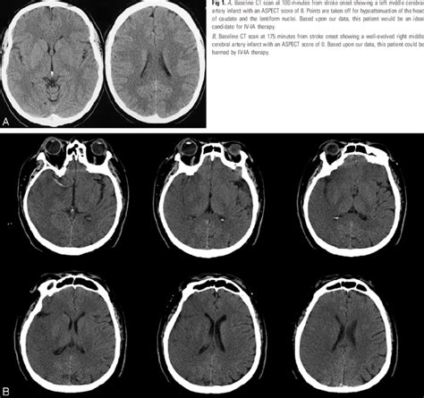 A Baseline Ct Scan At 100 Minutes From Stroke Onset Showing A Left