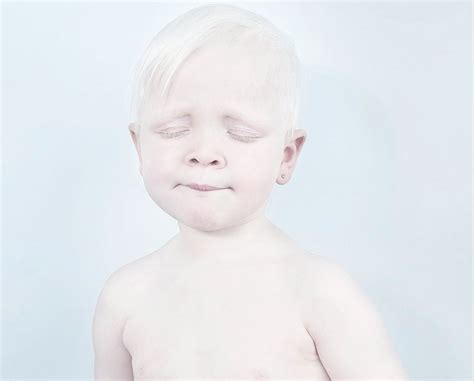 Photographers Capture The Unique Beauty Of Albino People