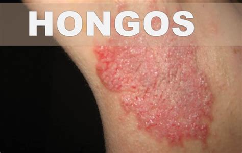 Por ello, el 10% de las afecciones dermatológicas en verano tienen. Remedios caseros para las infecciones por hongos - Como ...