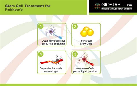 Parkinson's disease is a progressive nervous system disorder that affects movement. Parkinson's Treatment in India, Stem Cell Therapy for # ...