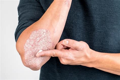 Psoriasis Dont Just Survive With It Thrive With It Siny Dermatology