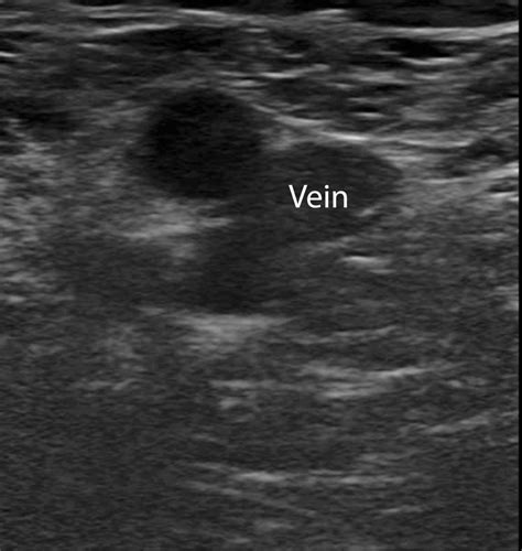 Venous Thrombosis Ultrasound