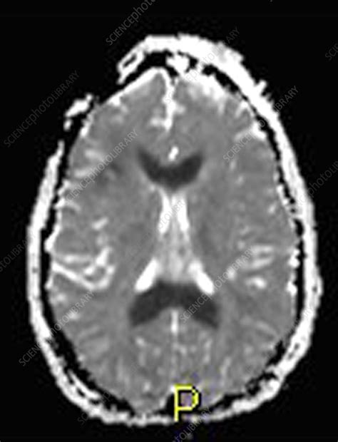 Severe Traumatic Brain Injury Mri Stock Image C0271726 Science