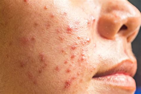 Cystic Acne Causes Symptoms Prevention And Treatment