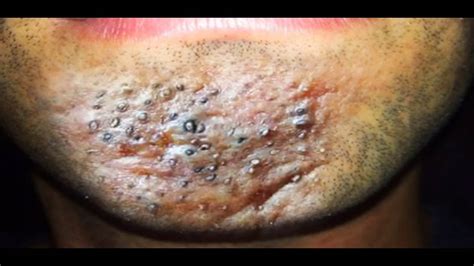 Blackhead Acne Inversa Boils Abscesses Wounds And Medical Discussion
