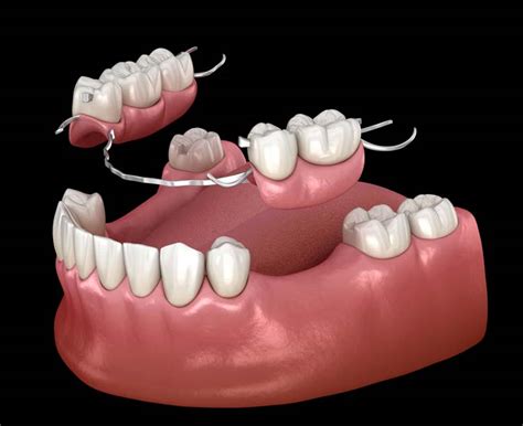 Partial Dentures Permanent Teeth Replacement Western Canada