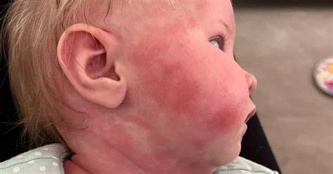 Mum Whose Baby Scratched Until She Bled Finds Miracle Eczema Cure