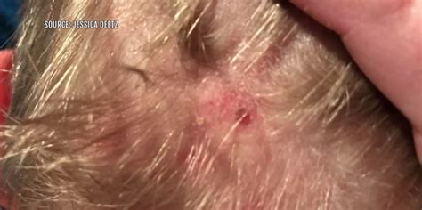 Customers Say Bald Spots Scalp Sores Linked To Hair Care Product ‘it