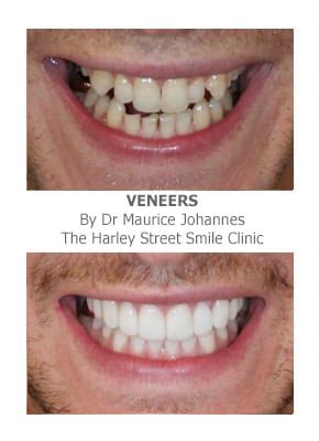 You can avoid metal braces and straighten your smile. Veneers for Crooked Teeth | Harley Street Smile Clinic