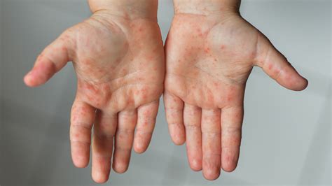 Hand Foot And Mouth Disease Children Raising Children Network
