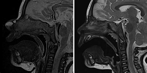 Nasal Dermoid Cysts With Intracranial Extension Avoiding Coronal