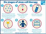 Pictures of Stem Cell Treatment For Hair Loss Side Effects