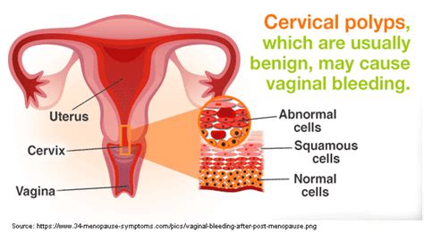Spotting or light bleeding after menopause might not seem like a serious problem, but you should never ignore it or wait to bring it up with your doctor. How serious is postmenopausal bleeding? - Women Fitness ...