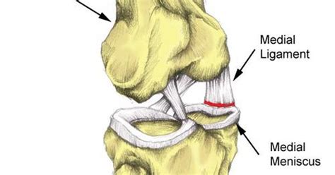 Medial Mensicus Tear Knee Pain Help And Healing Pinterest Knee