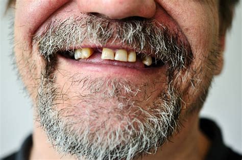 Toothless Man Pictures Images And Stock Photos Istock