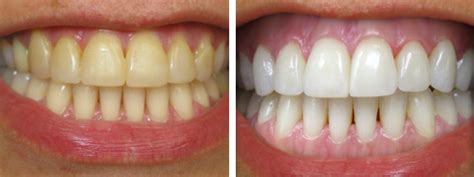 Coffee contains tannin that colors teeth with its compounds. Removing Coffee Stains From Teeth - Monroe Family Dentistry