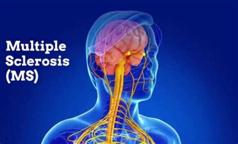 Neurological Disorders Types Symptoms Causes And Treatment