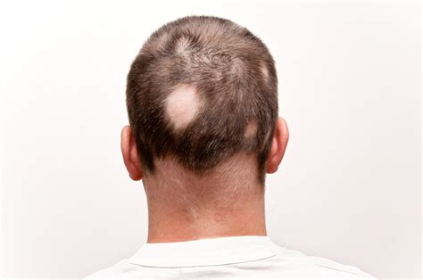 Alopecia Areata Cura E Cause