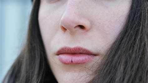 How To Get Rid Of Chapped Lips — Expert Tips And Recommendations Allure