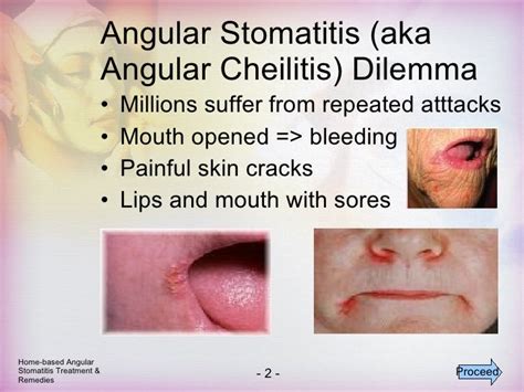 Angular Stomatitis Treatment Home Based Remedies And Treatment For