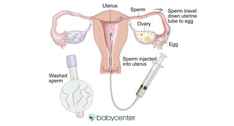 The actual iui procedure is quick and relatively painless, though there may be some discomfort. Fertility treatment: Intrauterine insemination (IUI ...