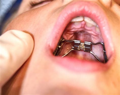 A crossbite is a type of malocclusion or a bite problem. Crossbite Explained