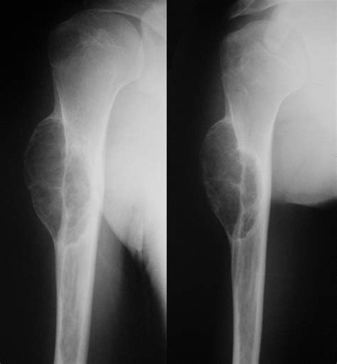 Aneurysmal Bone Cyst Of The Humerus A Report Of A Case Resolved By A