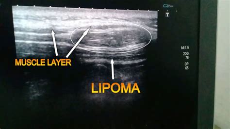 Interintramascular Lipoma Ultrasound Video Youtube