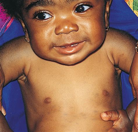 Extensive Mongolian Spots In An Infant With Hurler Syndrome