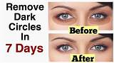 Home Remedies Bags Under Eyes Dark Circles Pictures