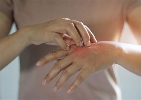 Orticaria sintomi e rimedi | Reckeweg Mystery Tales