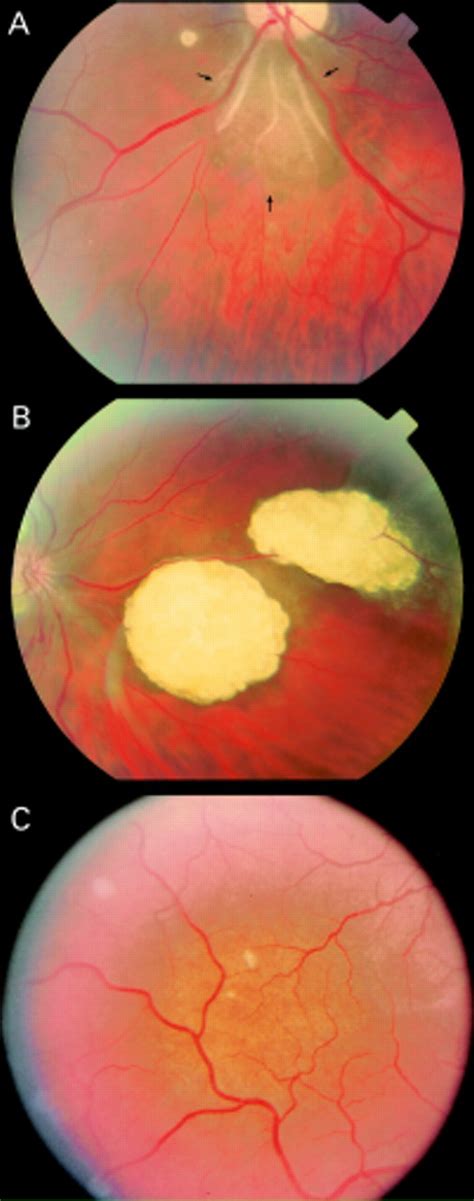 Retinal Hamartoma Tuberous Sclerosis