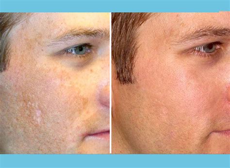 microneedling_before_after_blog2 - Denver Skin Care